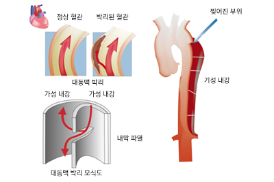 대동맥파열동맥경화박리증 7