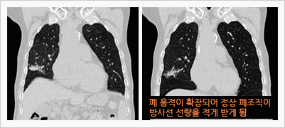 양압환기시스템을 이용한 방사선치료