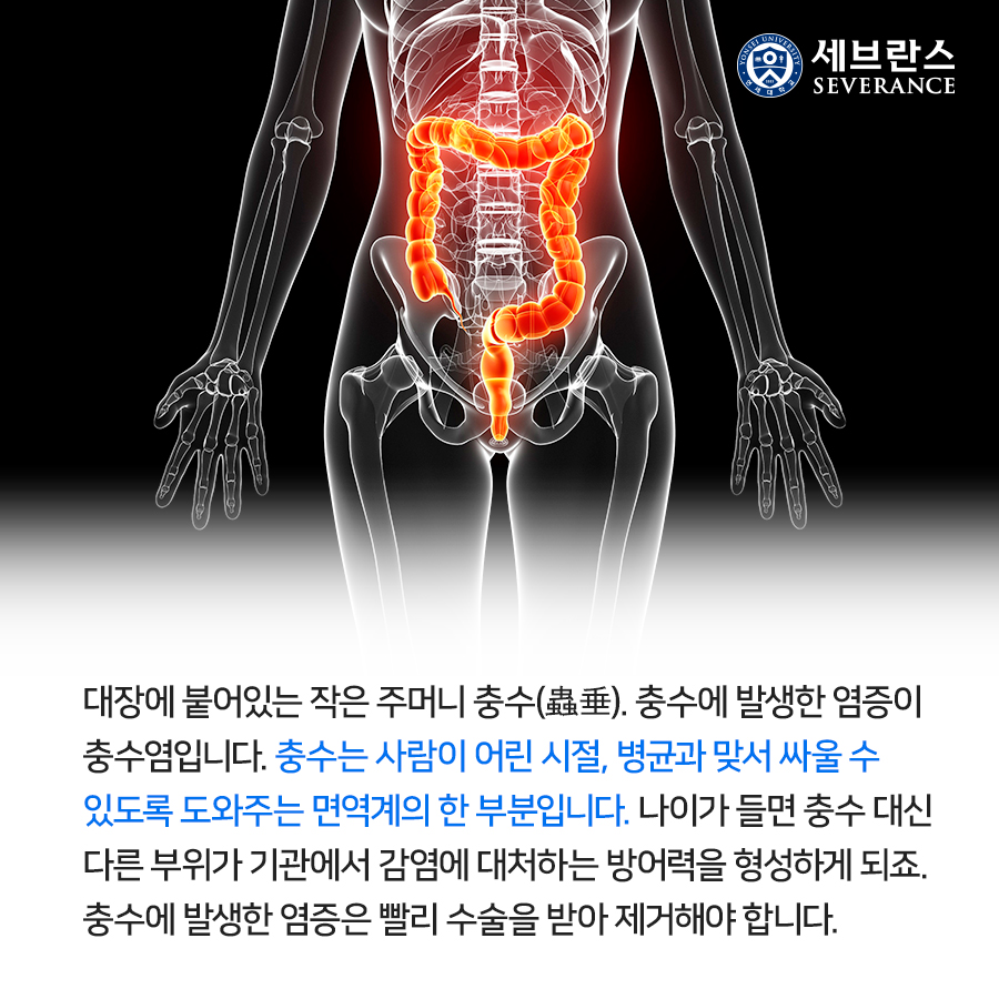 대장에 붙어있는 작은 주머니 충수(蟲垂).  충수에 발생한 염증이 충수염입니다.  충수는 사람이 어린 시절, 병균과 맞서 싸울 수 있도록 도와주는 면역계의 한 부분입니다. 나이가 들면 충수 대신 다른 부위가 기관에서 감염에 대처하는 방어력을 형성하게 되죠. 충수에 발생한 염증은 빨리 수술을 받아 제거해야 합니다.