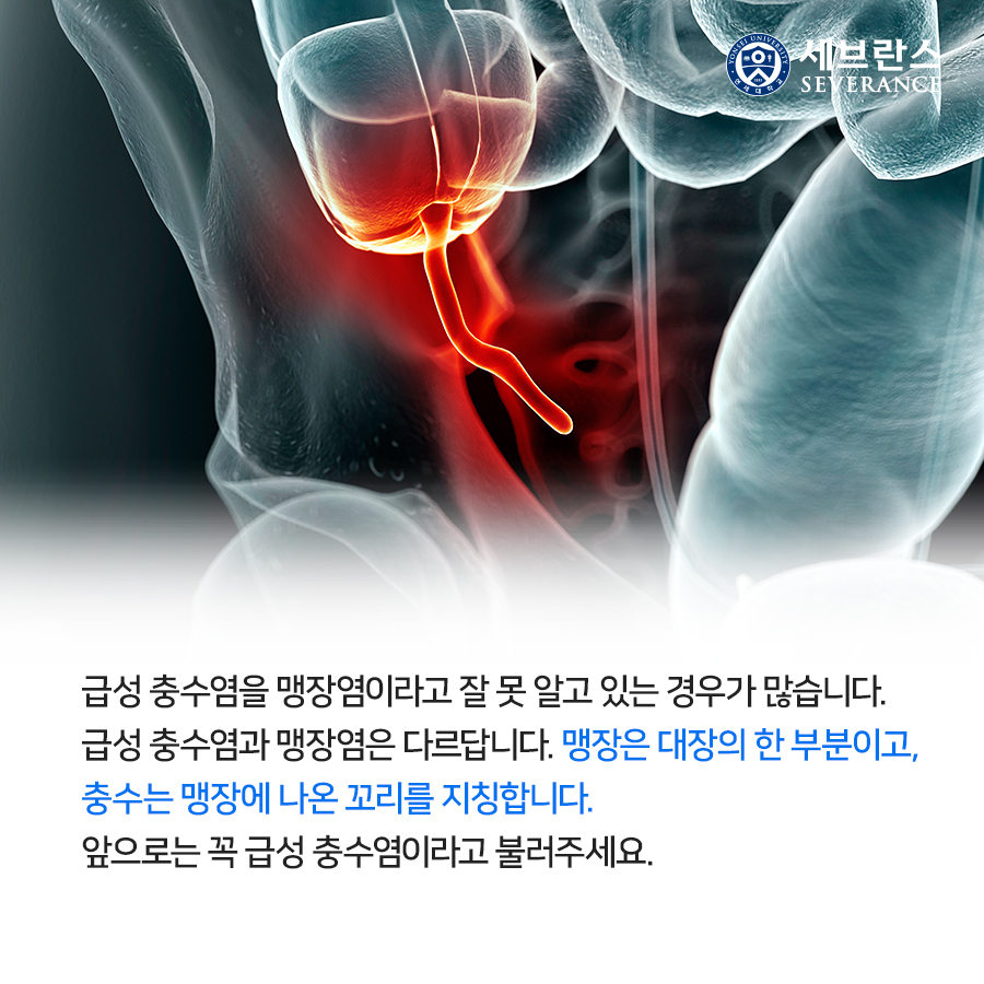 급성 충수염을 맹장염이라고 잘 못 알고 있는 경우가 많습니다. 급성 충수염과 맹장염은 다르답니다. 맹장은 대장의 한 부분이고, 충수는 맹장에 나온 꼬리를 지칭합니다. 앞으로는 꼭 급성 충수염이라고 불러주세요.