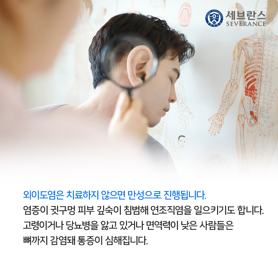 외이도염은 치료하지 않으면 만성으로 진행됩니다. 염증이 귓구멍 피부 깊숙이 침범해 연조직염을 일으키기도 합니다. 고령이거나 당뇨병을 앓고 있거나 면역력이 낮은 사람들은 뼈까지 감염돼 통증이 심해집니다.