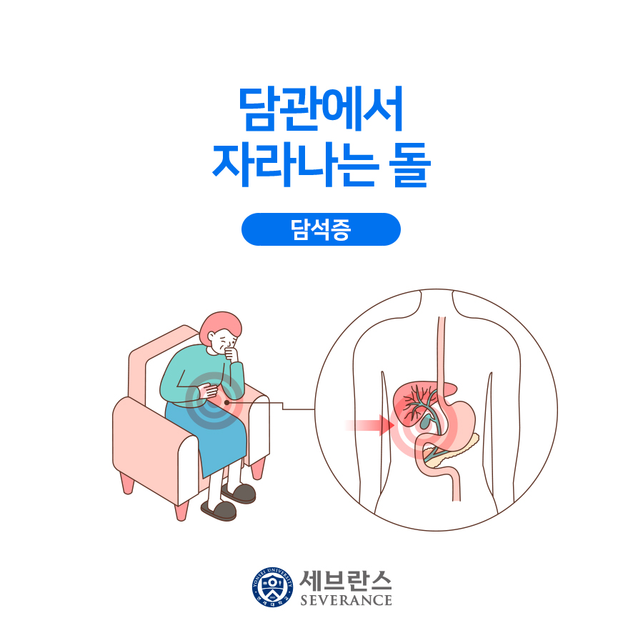 담관에서 자라나는 돌 - 담석증