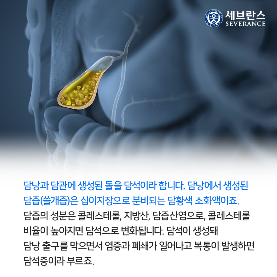 담낭과 담관에 생성된 돌을 담석이라 합니다. 담낭에서 생성된 담즙(쓸개즙)은 십이지장으로 분비되는 담황색 소화액이죠. 담즙의 성분은 콜레스테롤, 지방산, 담즙산염으로, 콜레스테롤 비율이 높아지면 담석으로 변화됩니다. 담석이 생성돼 담낭 출구를 막으면서 염증과 폐쇄가 일어나고 복통이 발생하면 담석증이라 부르죠.