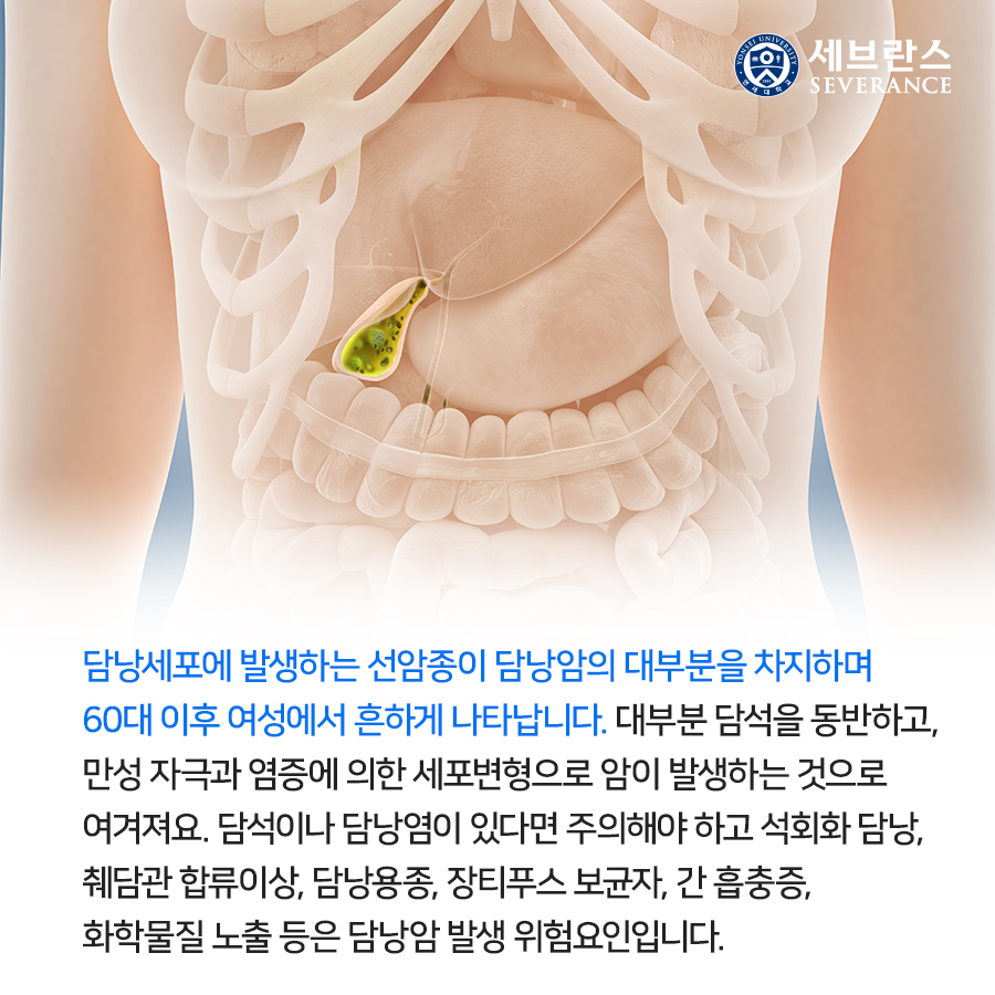 담낭세포에 발생하는 선암종이 댬낭암의 대부분을 차지하며 60대 이후 여성에서 흔하게 나타납니다. 대부분 담석을 동반하고, 만성 자극과 염증에 의한 세포변형으로 암이 발생하는 것으로 여겨져요.  담석이나 담낭염이 있다면 주의해야 하고 석회화 담낭, 췌담관 합류이상, 담낭용종, 장티푸스 보균자, 간 흡충증, 화학물질 노출 등은 담낭암 발생 위험요인입니다.