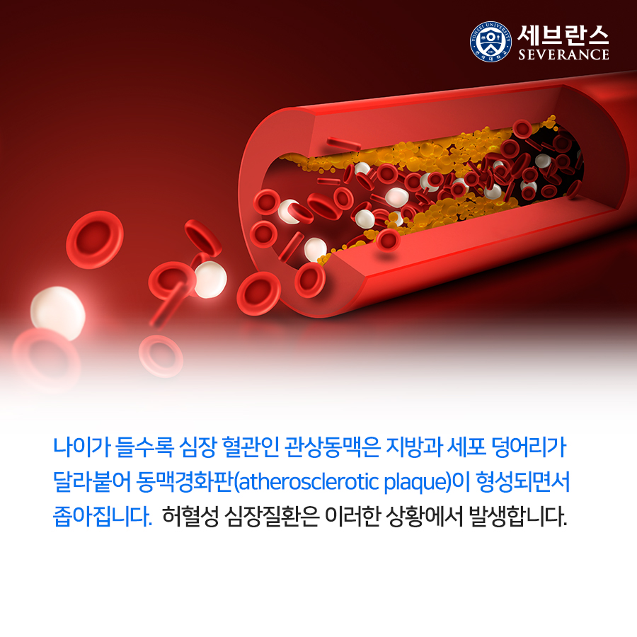 나이가 들수록 심장 혈관인 관상동맥은 지방과 세포 덩어리가 달라붙어 동맥경화판(atherosclerotic plaque)이 형성되면서 좁아집니다. 허혈성 심장질환은 이러한 상황에서 발생합니다.