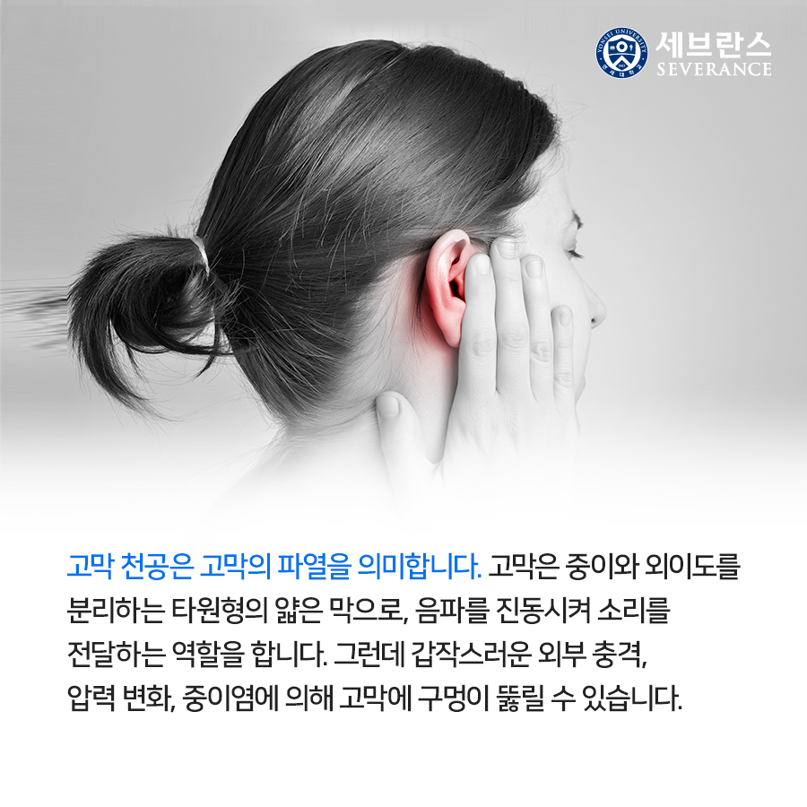 고막 천공은 고막의 파열을 의미합니다. 고막은 중이와 외이도를 분리하는 타원형의 얇은 막으로, 음파를 진동시켜 소리를 전달하는 역할을 합니다. 그런데 갑작스러운 외부 충격, 압력 변화, 중이염에 의해 고막에 구멍이 뚫릴 수 있습니다.