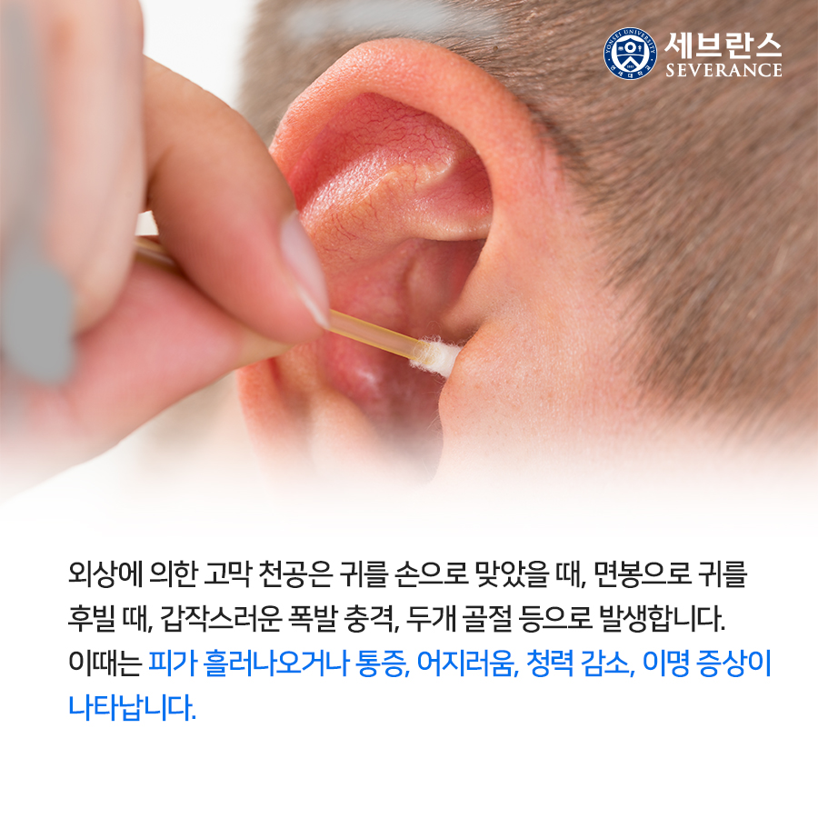 외상에 의한 고막 천공은 귀를 손으로 맞았을 때, 면봉으로 귀를 후빌 때, 갑작스러운 폭발 충격, 두개 골절 등으로 발생합니다. 이때는 피가 흘러나오거나 통증, 어지러움, 청력 감소, 이명 증상이 나타납니다.