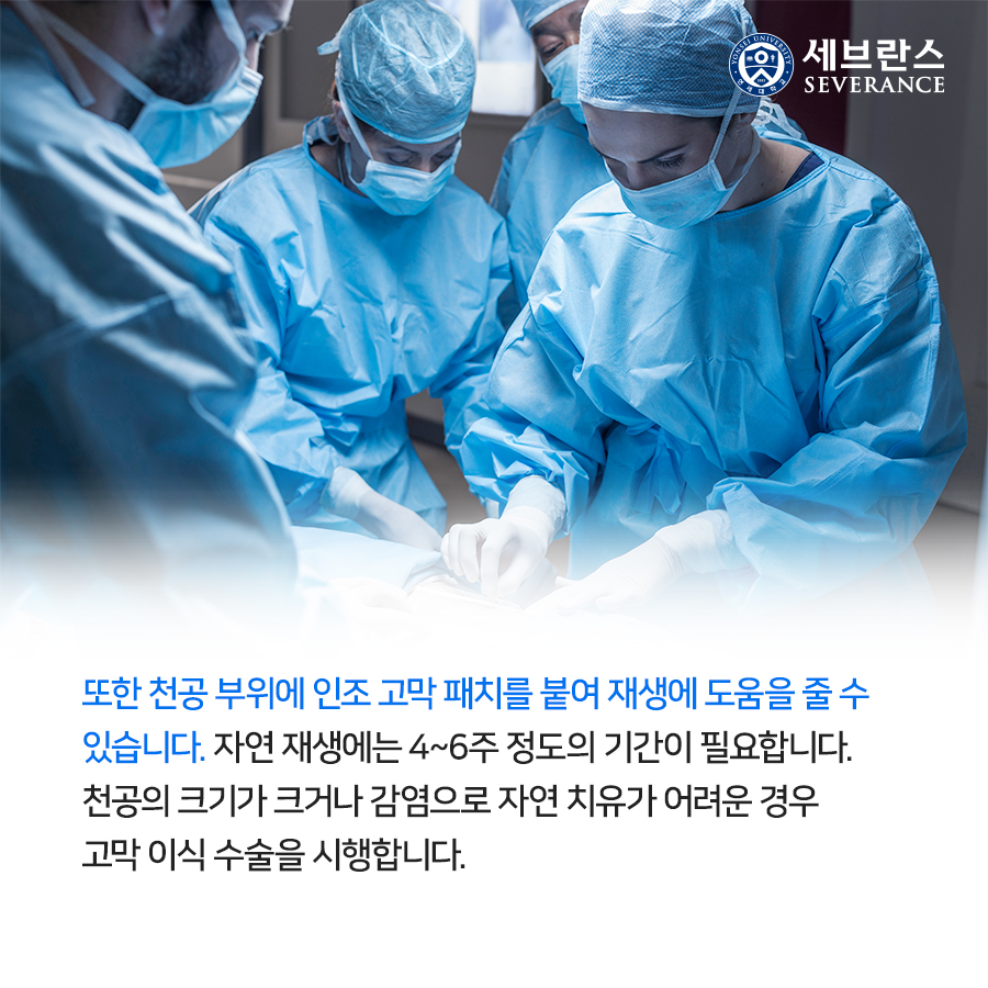 또한 천공 부위에 인조 고막 패치를 붙여 재생에 도움을 줄 수 있습니다. 자연 재생에는 4~6주 정도의 기간이 필요합니다. 천공의 크기가 크거나 감염으로 자연 치유가 어려운 경우 고막 이식 수술을 시행합니다. 