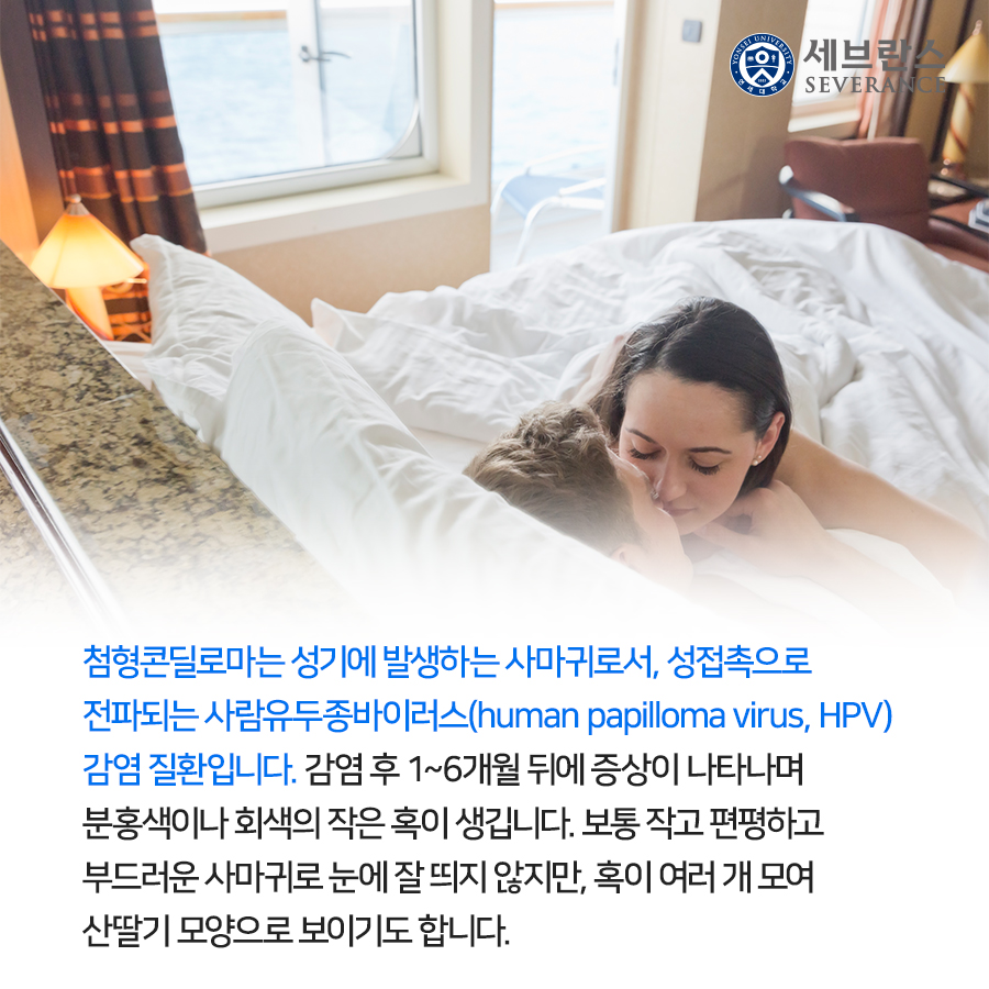 첨형콘딜로마는 성기에 발생하는 사마귀로서, 성접촉으로 전파되는 사람유두종바이러스(human papilloma virus, HPV) 감염 질환입니다.  감염 후 1~6개월 뒤에 증상이 나타나며 분홍색이나 회색의 작은 혹이 생깁니다.  보통 작고 편평하고 부드러운 사마귀로 눈에 잘 띄지 않지만, 혹이 여러 개 모여 산딸기 모양으로 보이기도 합니다.