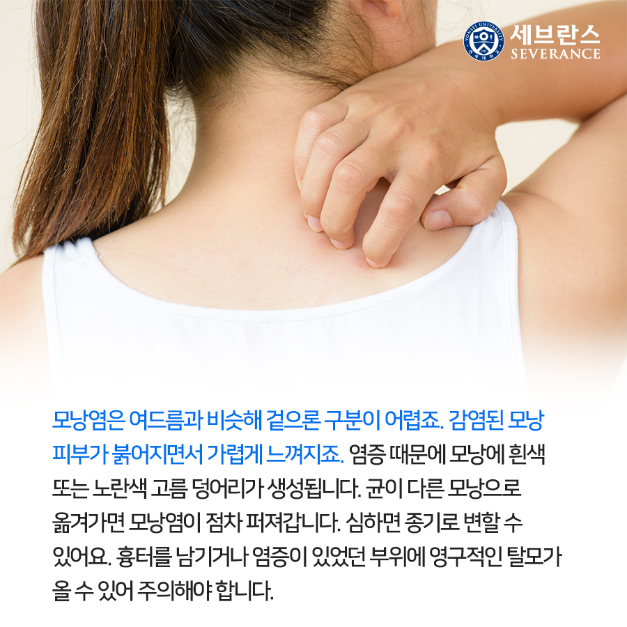 모낭염은 여드름과 비슷해 겉으론 구분이 어렵죠. 감염된 모낭 피부가 붉어지면서 가렵게 느껴지죠. 염증 때문에 모낭에 흰색 또는 노란색 고름 덩어리가 생성됩니다. 균이 다른 모낭으로 옮겨가면 모낭염이 점차 퍼져갑니다. 심하면 종기로 변할 수 있어요. 흉터를 남기거나 염증이 있었던 부위에 영구적인 탈모가 올 수 있어 주의해야 합니다.