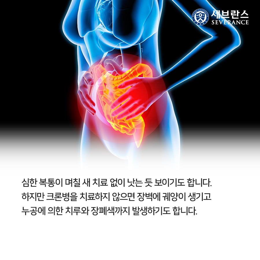 심한 복통이 며칠 새 치료 없이 낫는 듯 보이기도 합니다.  하지만 크론병을 치료하지 않으면 장벽에 궤양이 생기고  누공에 의한 치루와 장폐색까지 발생하기도 합니다. 