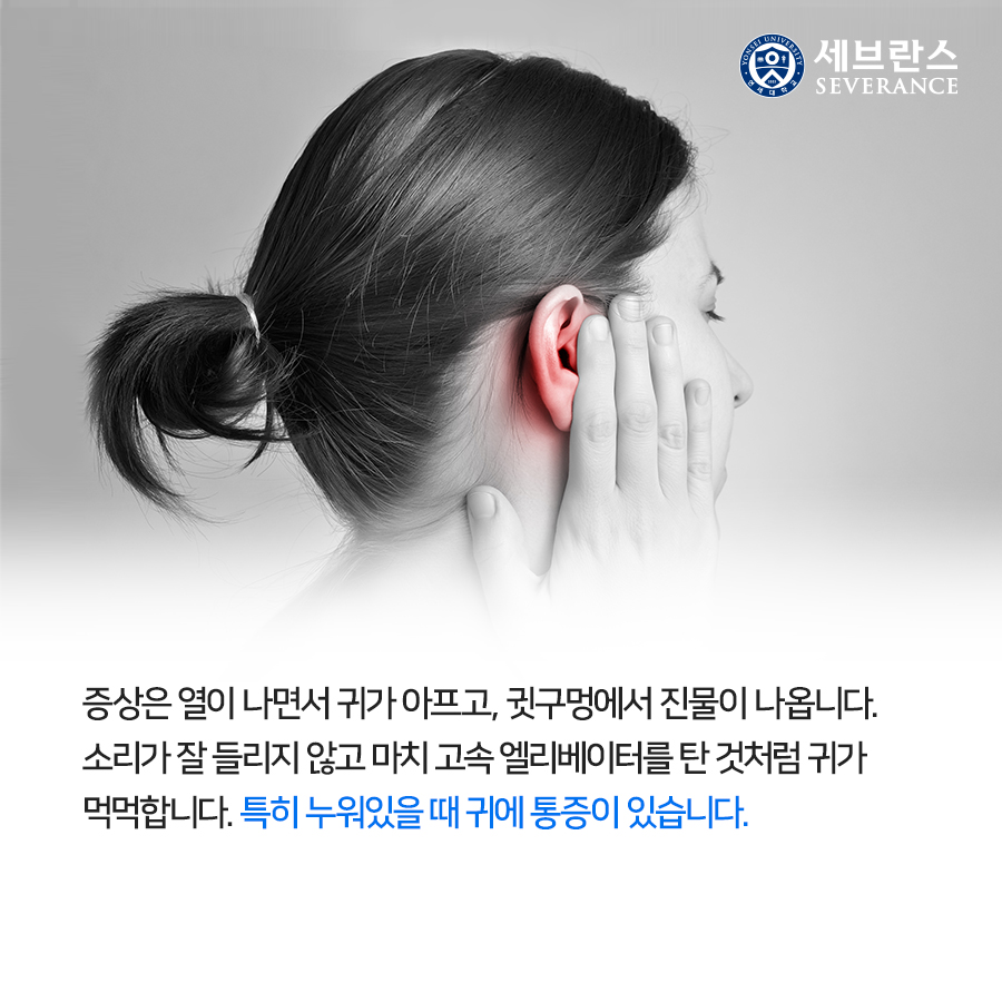 증상은 열이 나면서 귀가 아프고, 귓구멍에서 진물이 나옵니다. 소리가 잘 들리지 않고 마치 고속 엘리베이터를 탄 것처럼 귀가 먹먹합니다. 특히 누워있을 때 귀에 통증이 있습니다.