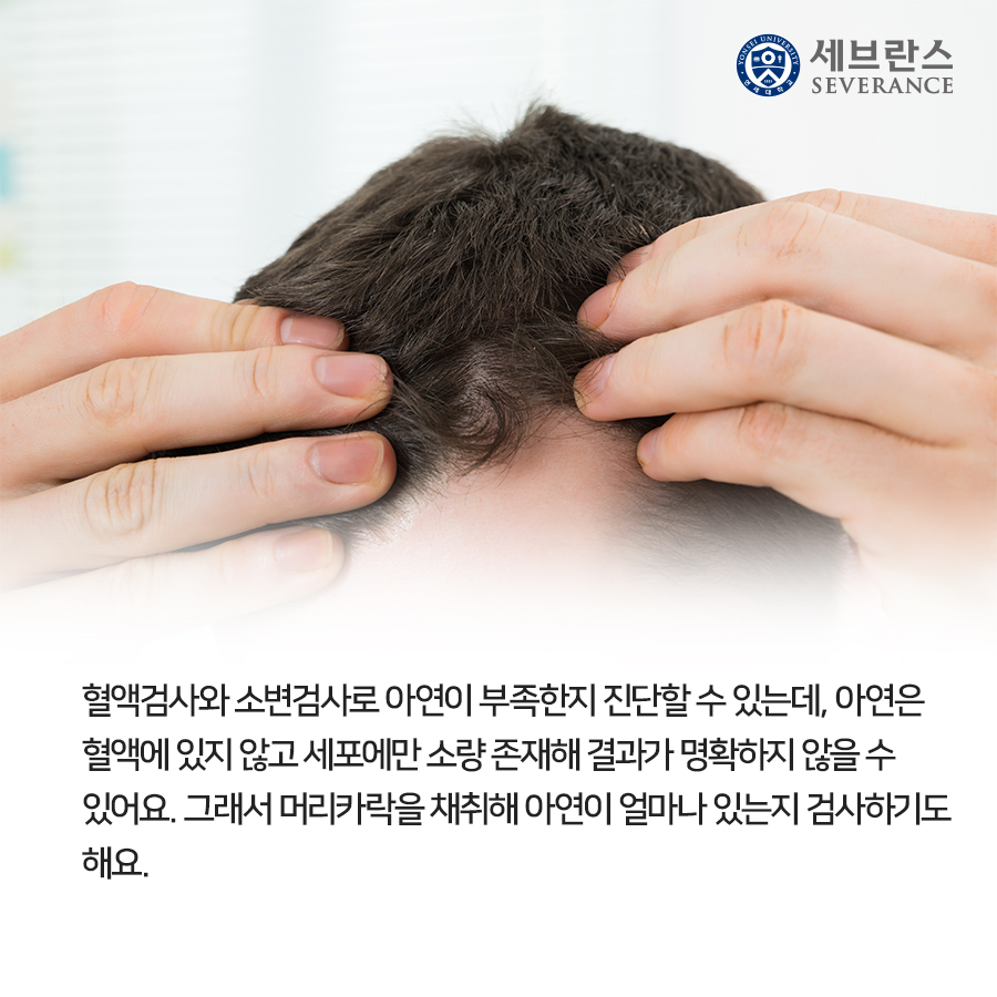 혈액검사와 소변검사로 아연이 부족한지 진단할 수 있는데, 아연은 혈액에 있지 않고 세포에만 소량 존재해 결과가 명확하지 않을 수 있어요. 그래서 머리카락을 채취해 아연이 얼마나 있는지 검사하기도 해요.
