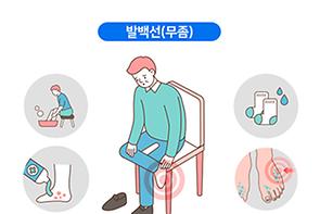 발 백선