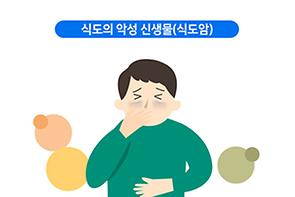 식도암