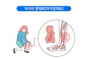 하지정맥류