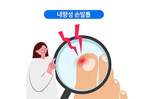 내향성 손발톱