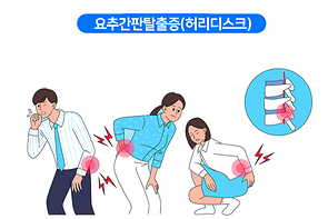 요추간판탈출증(허리디스크)