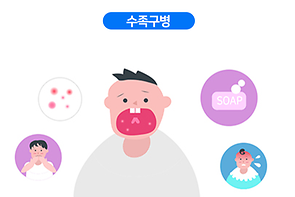 수족구병