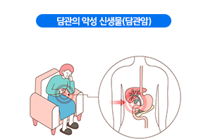 담관의-악성-신생물(담관암)