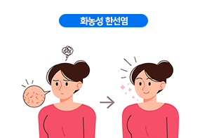 화농성 한선염