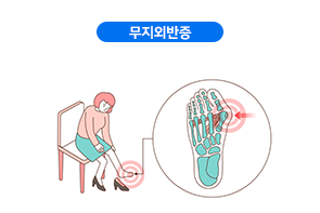 무지외반증