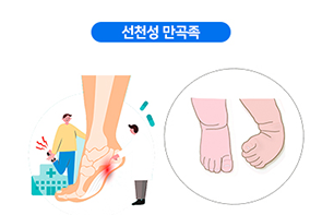 선천성 만곡족