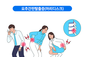 요추간판탈출증(허리디스크)
